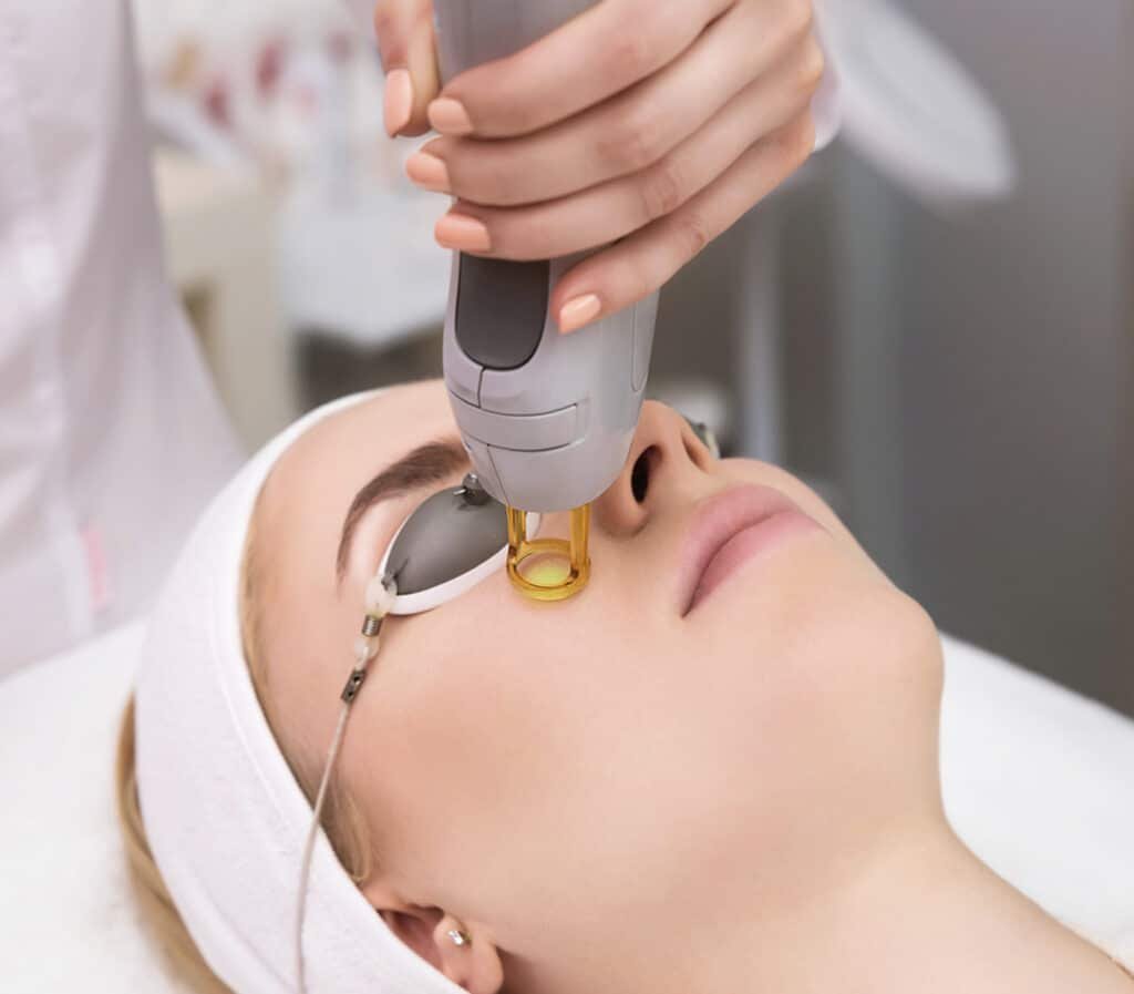 Une femme allongée sur une table de soin subissant une épilation laser, portant des lunettes de protection. Un appareil de traitement est tenu près de son visage par un professionnel de la santé.