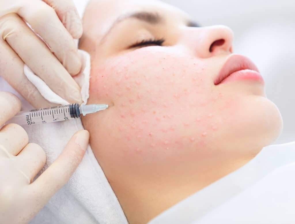 Une femme recevant un traitement facial avec une seringue, montrant des rougeurs sur sa peau, dans un environnement de soins de la peau.