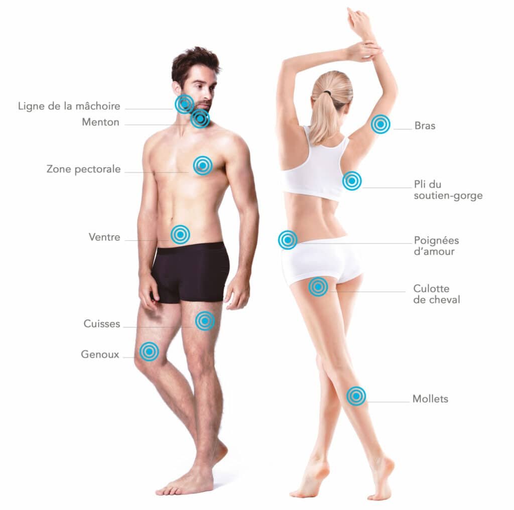 Cryolipolyse-paris-les-zones-traitees