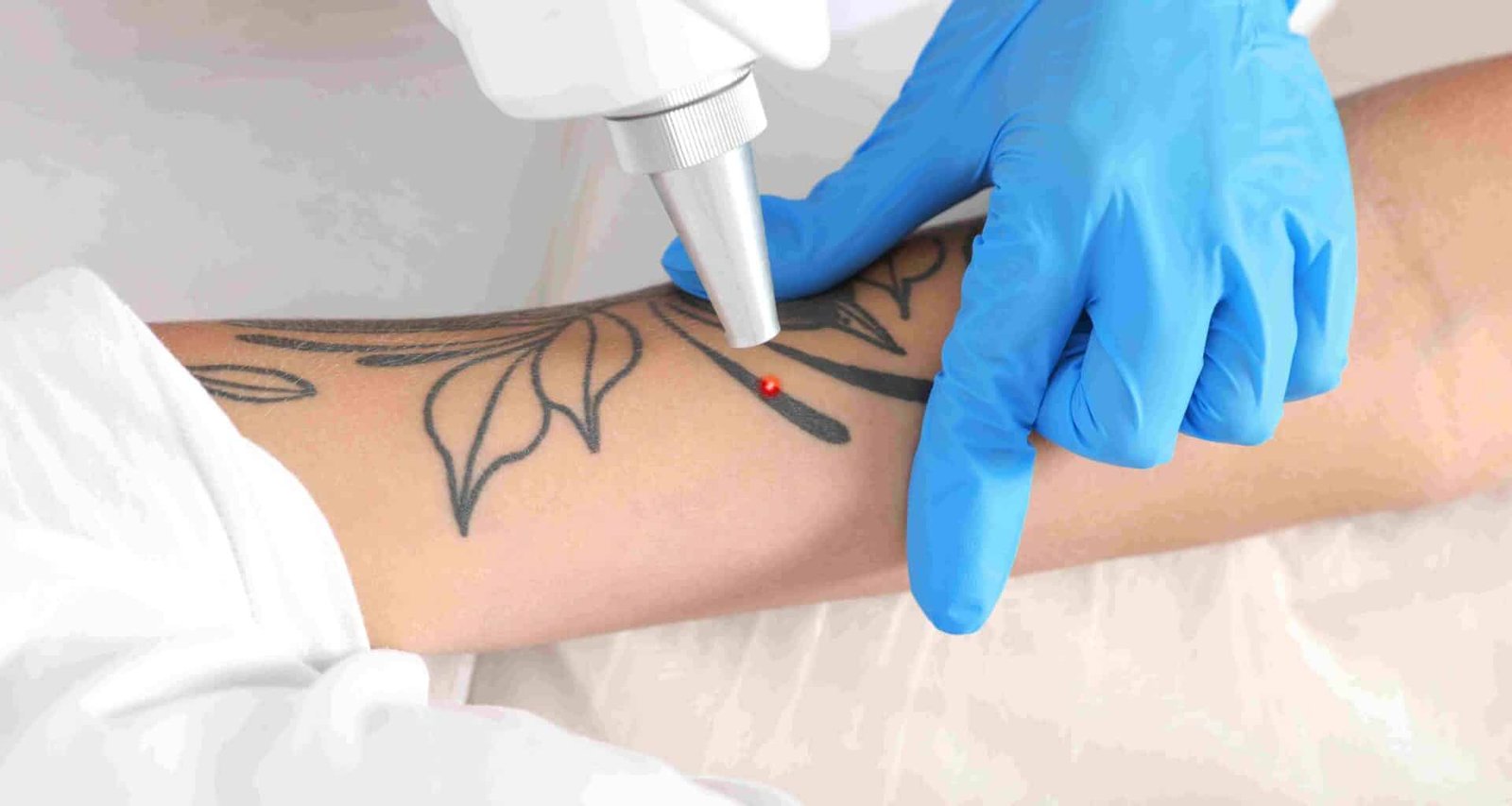 Laser détatouage tatouage bras femme séance effacement tatouage institut esthétique Paris