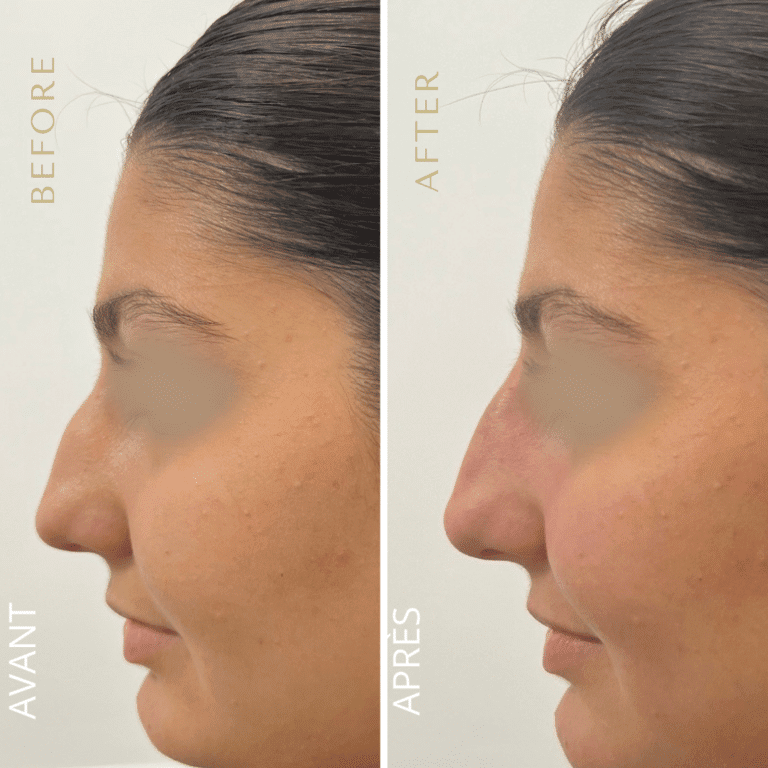 Résultat rhinoplastie sans chirurgie correction nez avant après institut esthétique Paris