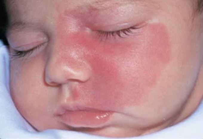 Photo d’un angiome infantile sur le visage d’un bébé, pris en charge par nos dermatologues spécialisés à Paris