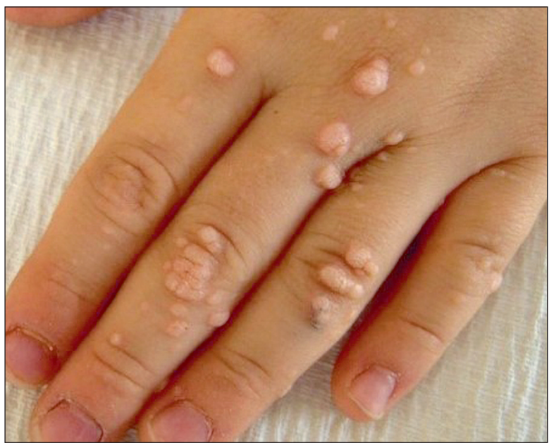 Boutons arrondis de molluscum contagiosum visibles sur le dos et les doigts de la main