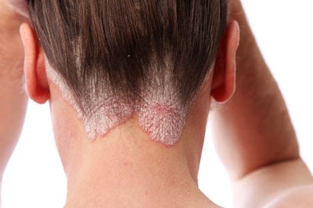 Psoriasis cou plaques rouges peau sèche avec squames – soin dermatologique Paris