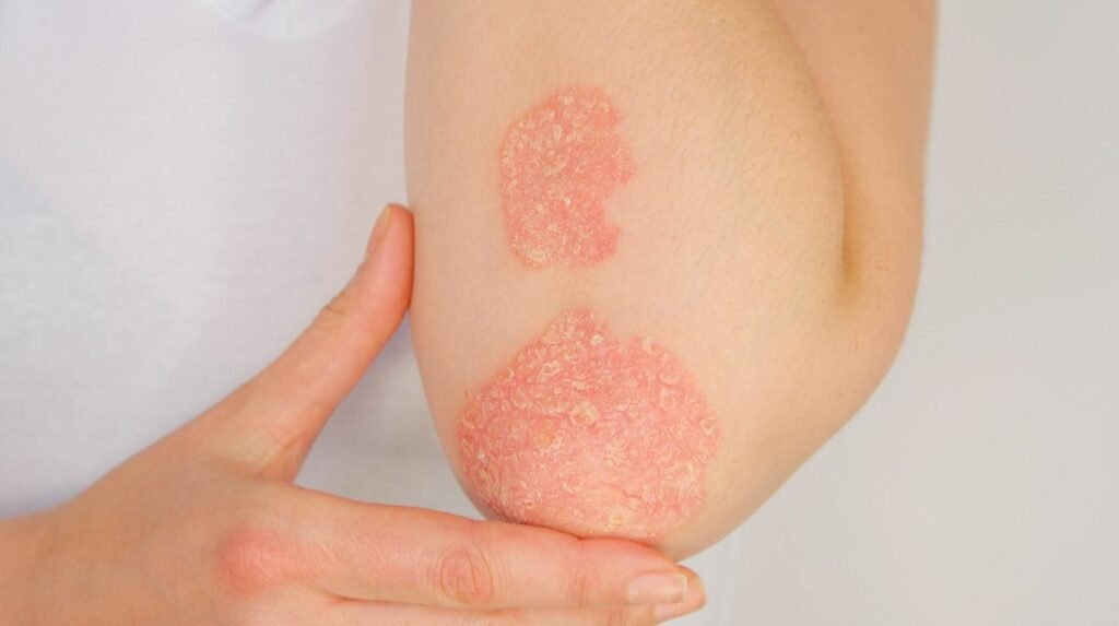 Plaques de psoriasis sur le coude – lésions cutanées rouges et squameuses – traitement dermatologique Paris Centre du Champ de Mars