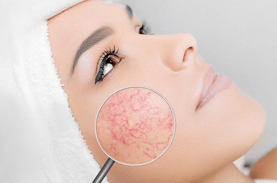 Couperose peau rougeurs visage vaisseaux visibles traitement laser Paris