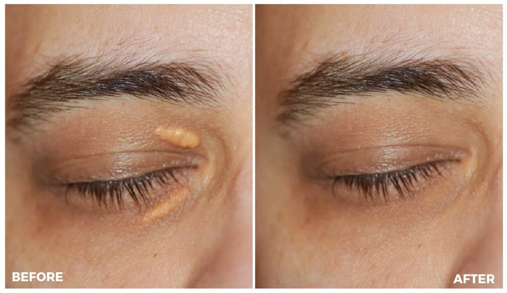 Avant après retrait xanthélasma sur la paupière – traitement des dépôts de cholestérol sous les yeux Paris 7