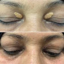 Avant après retrait xanthélasma sur les paupières – traitement des dépôts de cholestérol sous les yeux Paris 7
