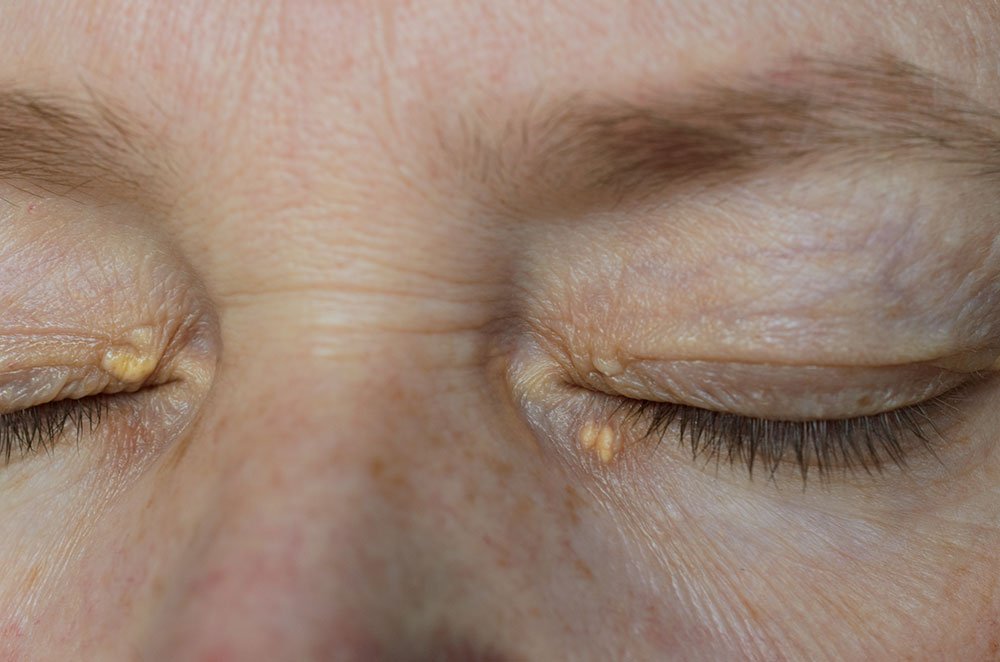 Traitement xanthélasma paupière avant après – suppression des plaques lipidiques yeux Paris