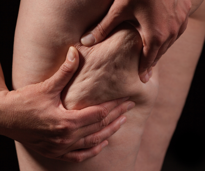 Cellulite cuisse peau d’orange capitons traitement cellulite Paris