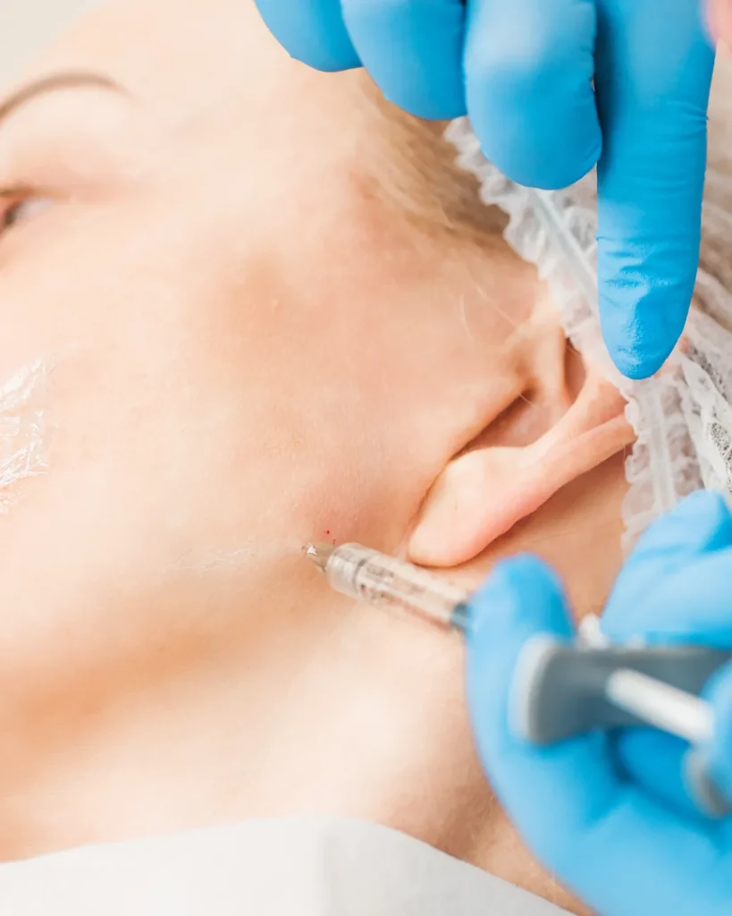Une femme reçoit des injections d'acide hyaluronique pour l'ovale du visage.