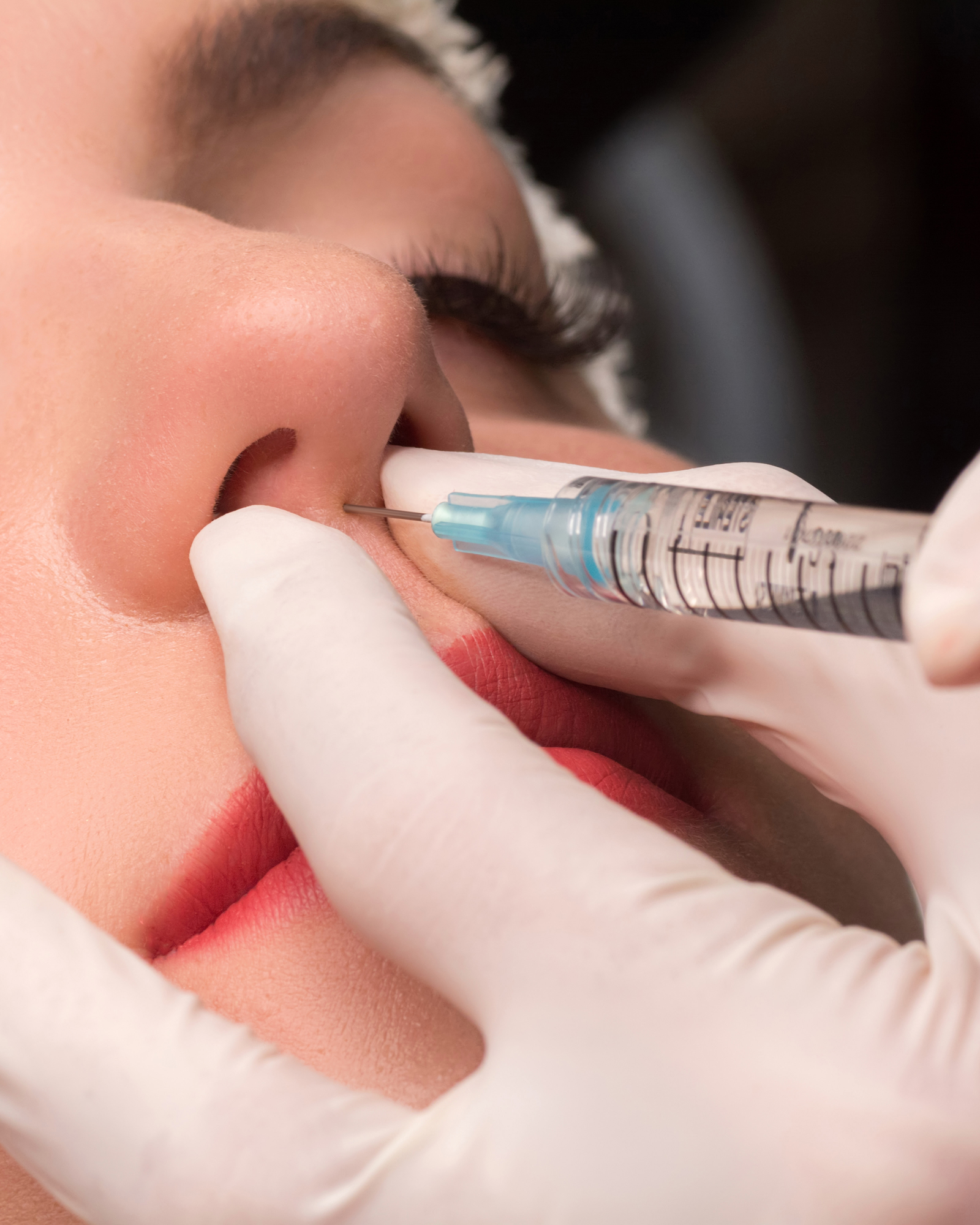 Une femme subit une rhinoplastie