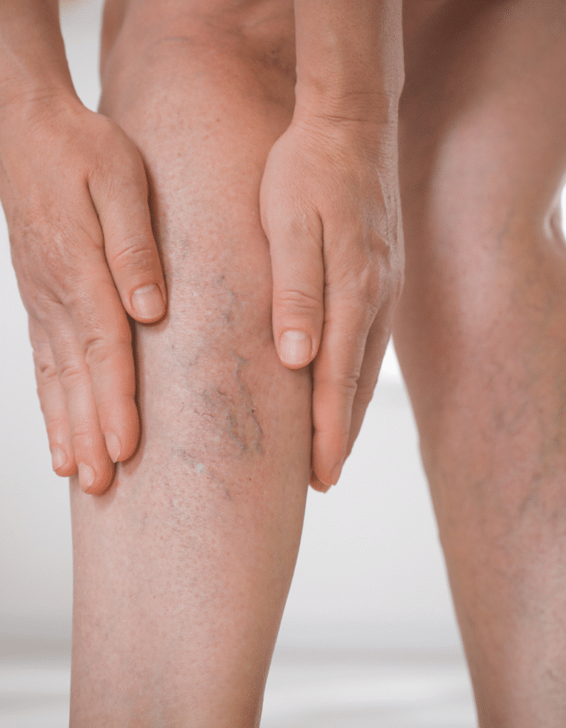 Gros plan sur une jambe présentant des varicosités, les mains entourant la zone affectée.