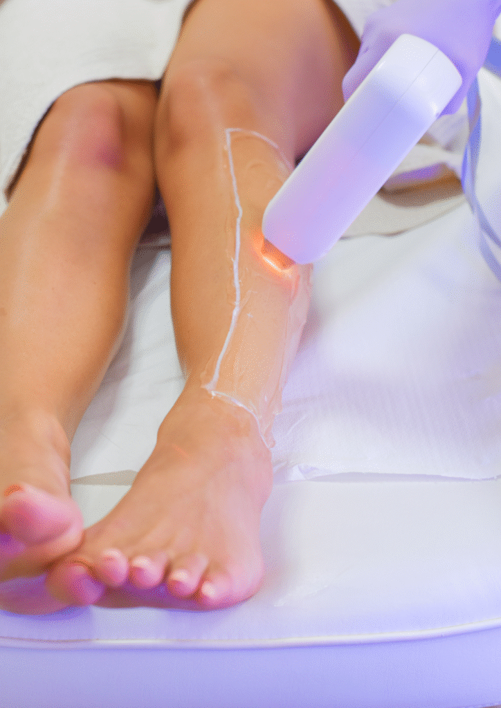 Application d’un laser sur les jambes pour une épilation définitive