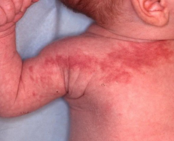 Photo d’un bébé présentant un angiome plan rouge étendu sur le bras et l’épaule, nécessitant un suivi dermatologique spécialisé