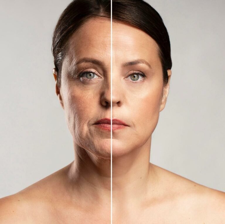 Endolift femme