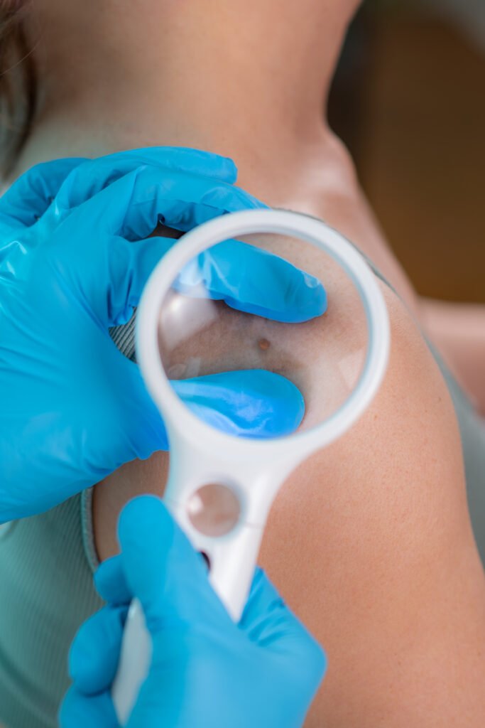Dermatologue examinant un acrochordon sur l’épaule d’une patiente avec une loupe médicale