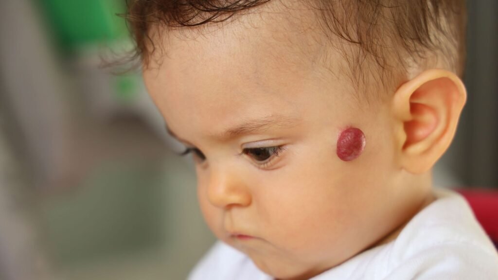 Nourrisson présentant un angiome sur la joue, consultation de dermatologie infantile à Paris