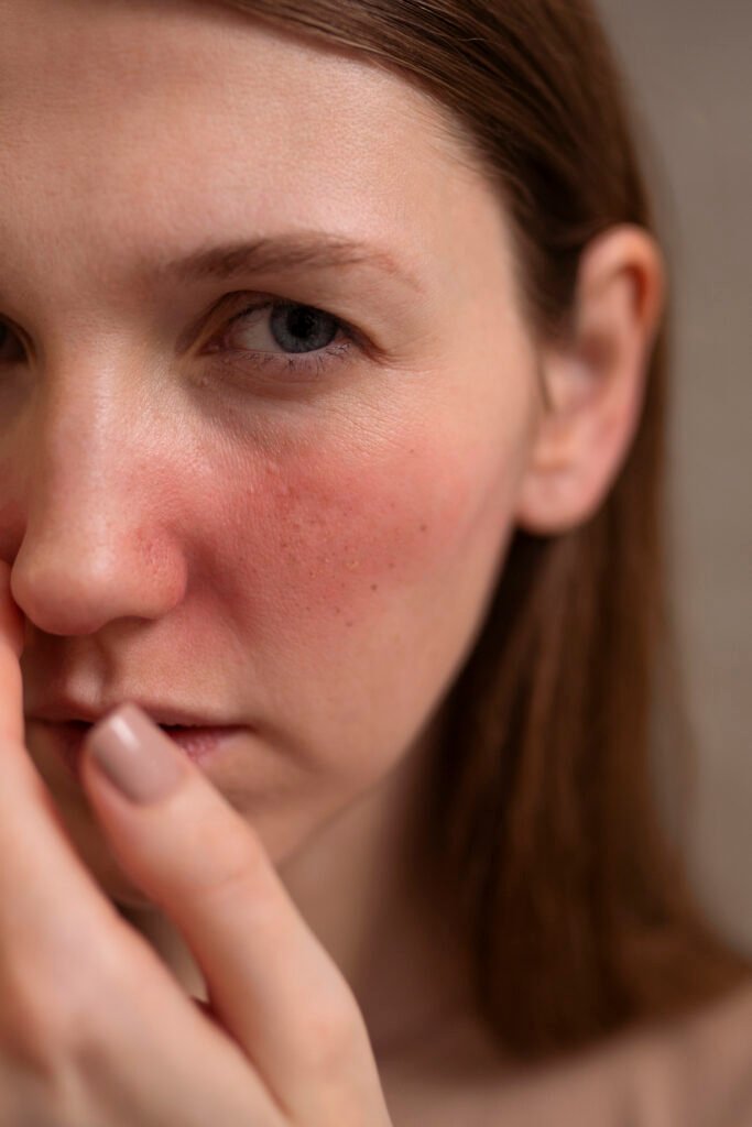 Femme touchant sa joue avec érythrose visible, signe de rosacée nécessitant un traitement dermatologique adapté