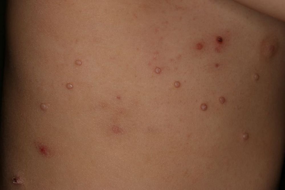 Multiples lésions arrondies de molluscum contagiosum visibles sur la peau du tronc