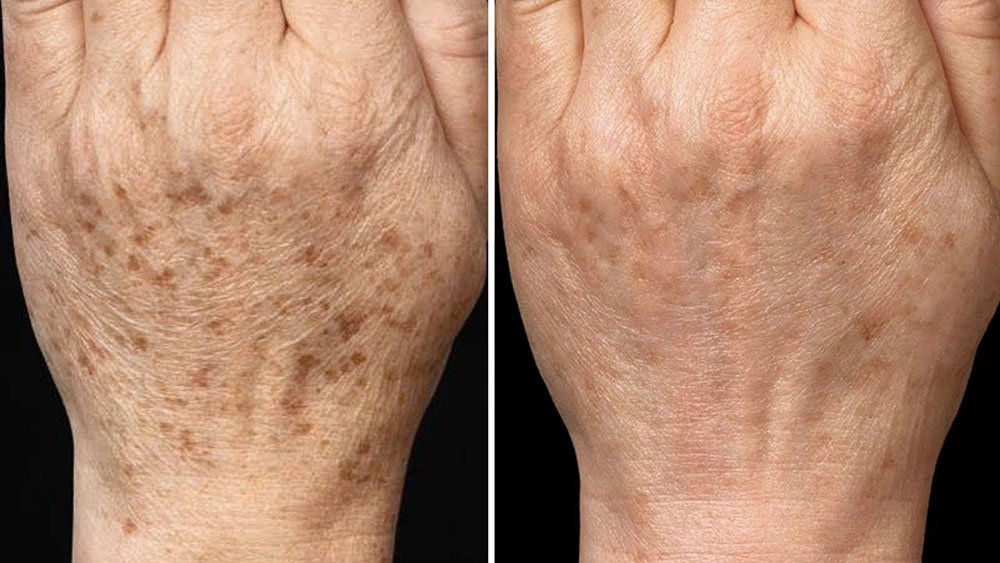 Comparaison avant et après traitement du lentigo sur les mains, avec disparition progressive des taches brunes