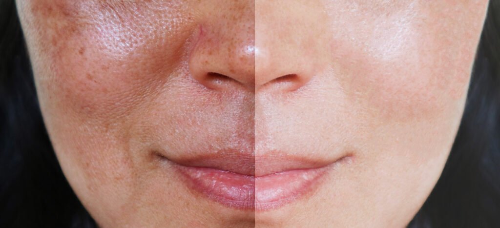 Comparaison du visage avant et après traitement du lentigo, avec atténuation des taches brunes et peau plus uniforme