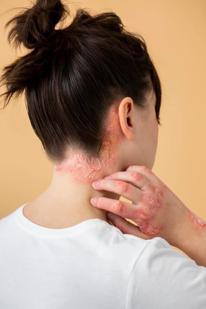 eczema de psoriasis sur le cou du patient