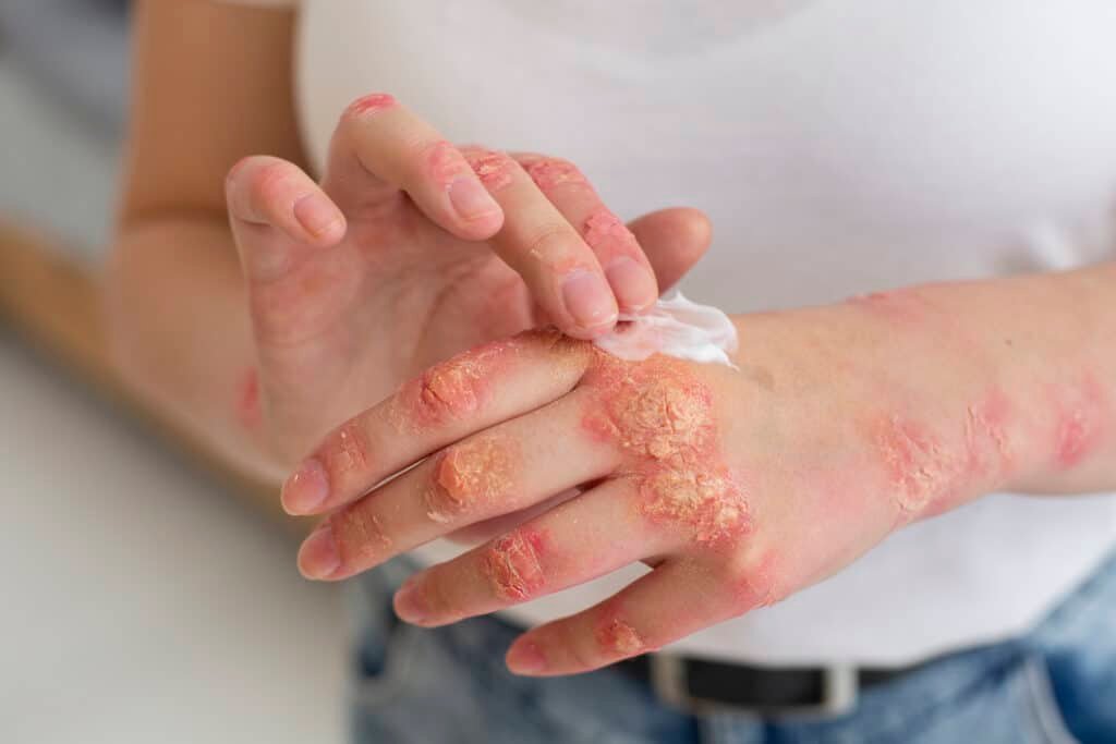 mains d un patient souffrant de psoriasis