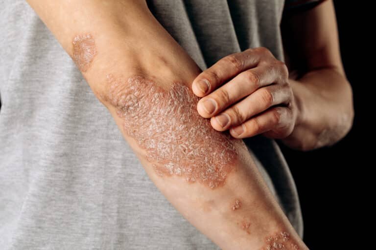 psoriasis 2