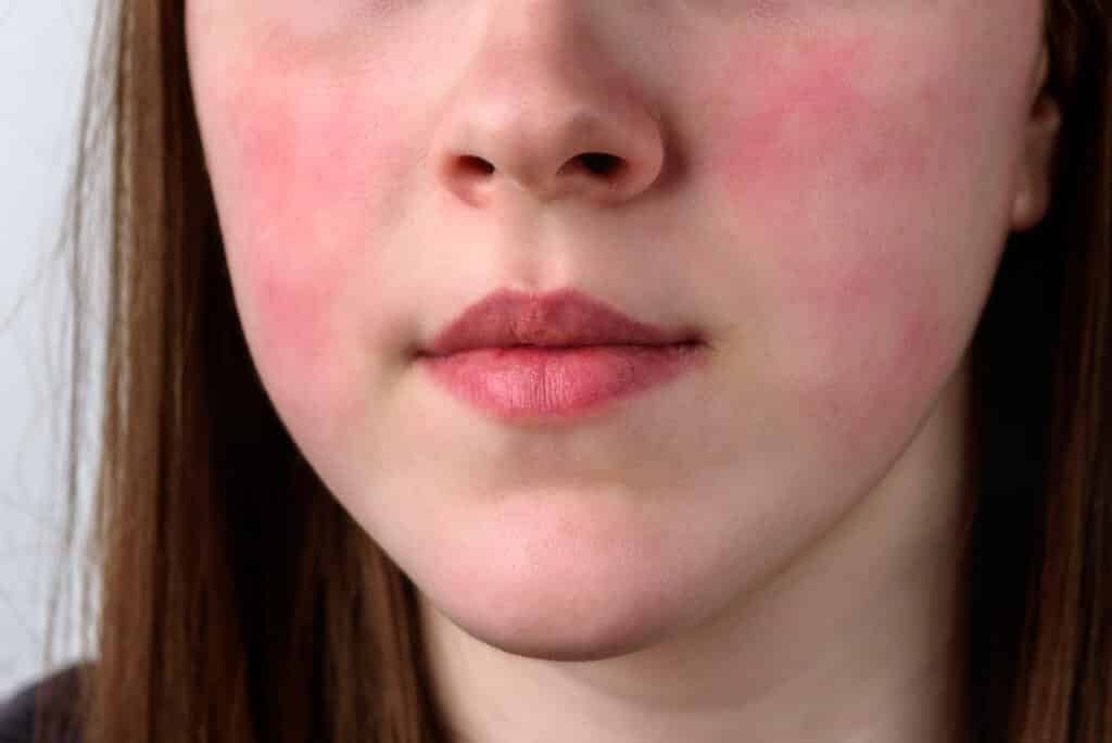 rosacee sur joue de femme frontale