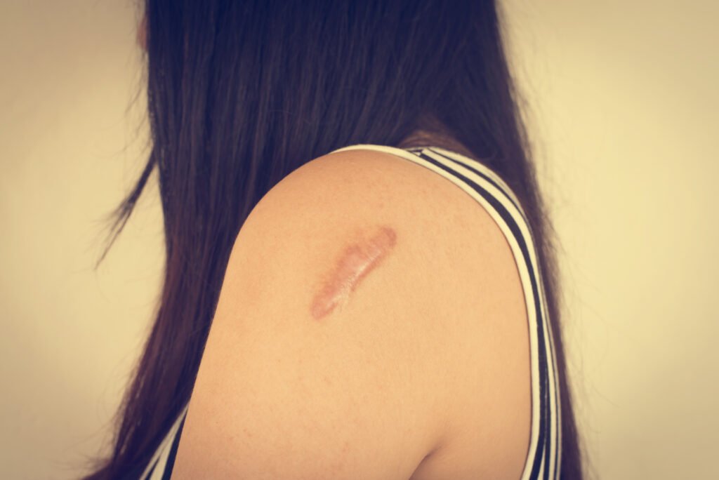 femme avec une cicatrice sur son bras
