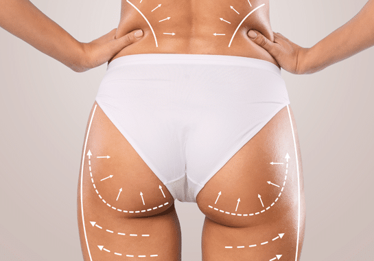 BBL – augmentation des fesses par lipofilling réalisée par un chirurgien esthétique dans un cadre médical sécurisé