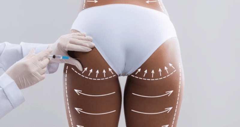 BBL non chirurgical par injections d’acide hyaluronique pour améliorer le galbe des fesses sans chirurgie