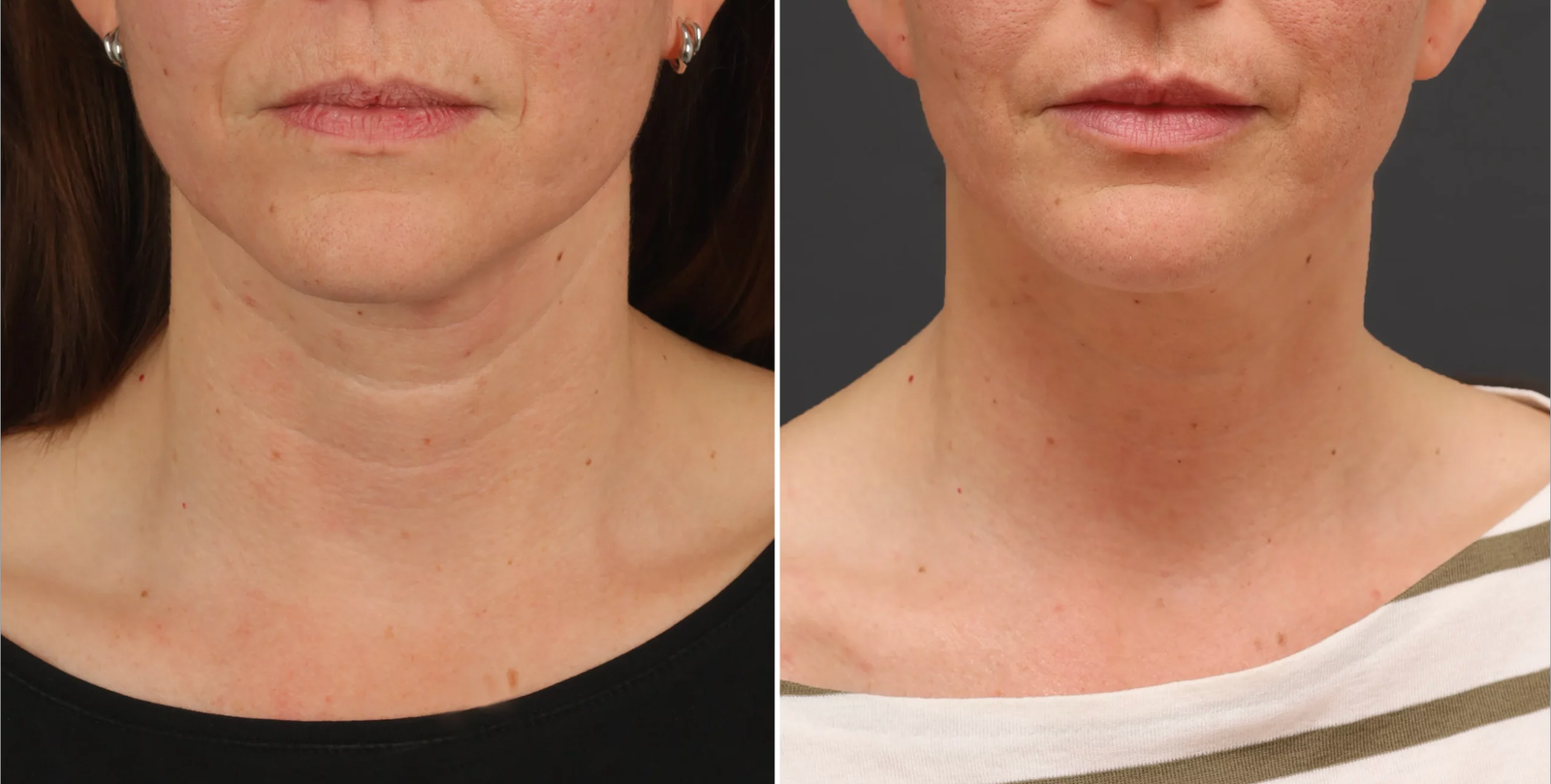 Avant après SkinBooster à Paris : amélioration de la qualité de peau et de l’hydratation