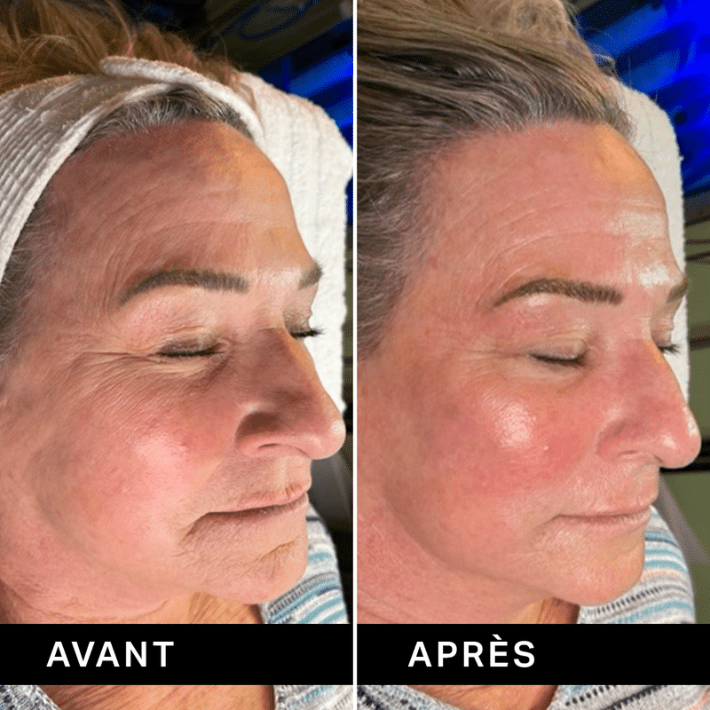 Hydrafacial avant après à Paris montrant amélioration de l’éclat et du grain de peau