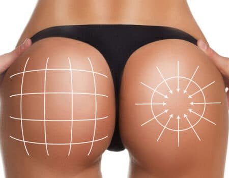Meilleur BBL Paris sans chirurgie – augmentation du fessier par injections d’acide hyaluronique réalisée par médecin au Centre du Champ de Mars