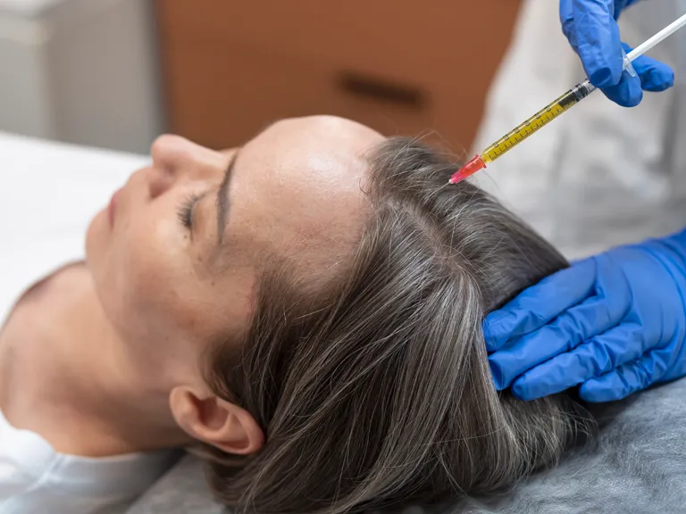 Injection de PRP capillaire chez une femme réalisée par un médecin à Paris pour traiter la chute de cheveux et stimuler la densité capillaire féminine.