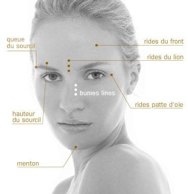 Schéma des principales zones d’injection du Botox sur le visage à Paris
