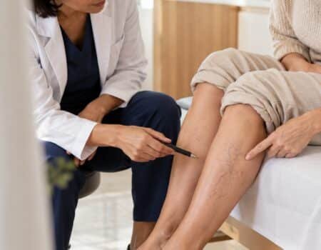 varicosités des jambes visibles sur le mollet pendant une évaluation médicale avant laser